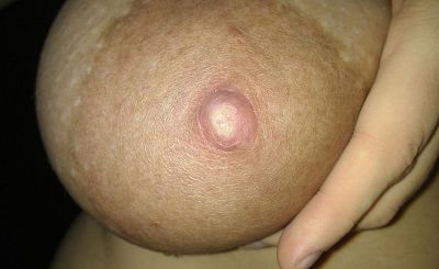 Lactamedia_00035_Raynaud on nipple - white_high